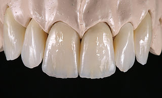 Dental crowns and bridges Yorkville, Cosmetic Dentistry offered by Dr. Mario Rotella