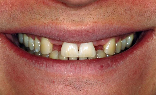 PDental Implants in Toronto by Dr. Mario Rotella