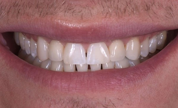 PDental Implants in Toronto by Dr. Mario Rotella