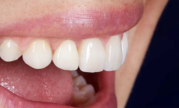 Porcelain Veneers in Toronto by Dr. Mario Rotella